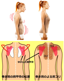 巻肩による肩こり